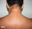 reticular erythematous mucinosis