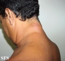 reticular erythematous mucinosis