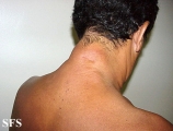 reticular erythematous mucinosis