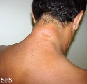 reticular erythematous mucinosis