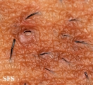 pseudofolliculitis barbae
