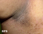 pseudo-acanthosis nigricans