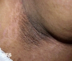 pseudo-acanthosis nigricans