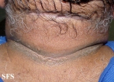 pseudo-acanthosis nigricans