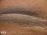 pseudo-acanthosis nigricans
