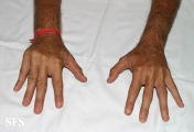 dupuytren contracture
