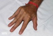 dupuytren contracture