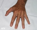 dupuytren contracture