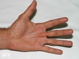 dupuytren contracture