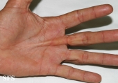 dupuytren contracture