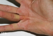 dupuytren contracture