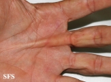 dupuytren contracture