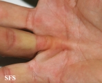 dupuytren contracture