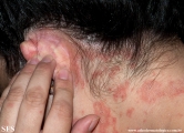 psoriasis-pustular psoriasis