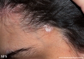 psoriasis-pustular psoriasis