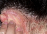 psoriasis-pustular psoriasis