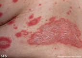 psoriasis-pustular psoriasis