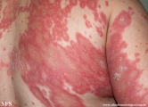 psoriasis-pustular psoriasis