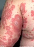 psoriasis-pustular psoriasis