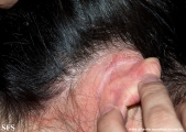 psoriasis-pustular psoriasis