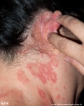 psoriasis-pustular psoriasis