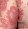 psoriasis-pustular psoriasis