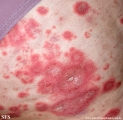 psoriasis-pustular psoriasis