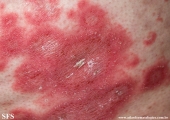 psoriasis-pustular psoriasis