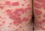 psoriasis-pustular psoriasis