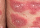 psoriasis-pustular psoriasis