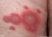 psoriasis-pustular psoriasis