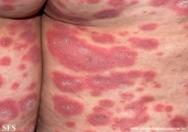 psoriasis-pustular psoriasis