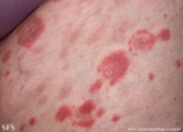 psoriasis-pustular psoriasis