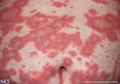psoriasis-pustular psoriasis