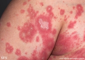 psoriasis-pustular psoriasis