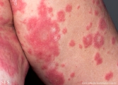 psoriasis-pustular psoriasis