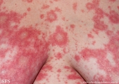 psoriasis-pustular psoriasis