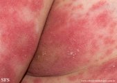 psoriasis-pustular psoriasis