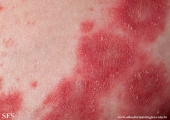 psoriasis-pustular psoriasis