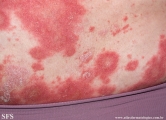 psoriasis-pustular psoriasis