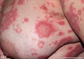 psoriasis-pustular psoriasis