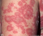 psoriasis-pustular psoriasis