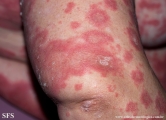 psoriasis-pustular psoriasis