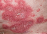 psoriasis-pustular psoriasis