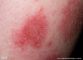 psoriasis-pustular psoriasis