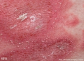 psoriasis-pustular psoriasis