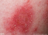 psoriasis-pustular psoriasis