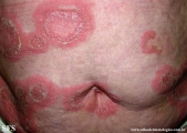 psoriasis-pustular psoriasis