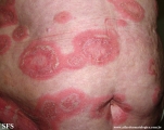 psoriasis-pustular psoriasis