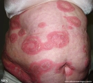 psoriasis-pustular psoriasis